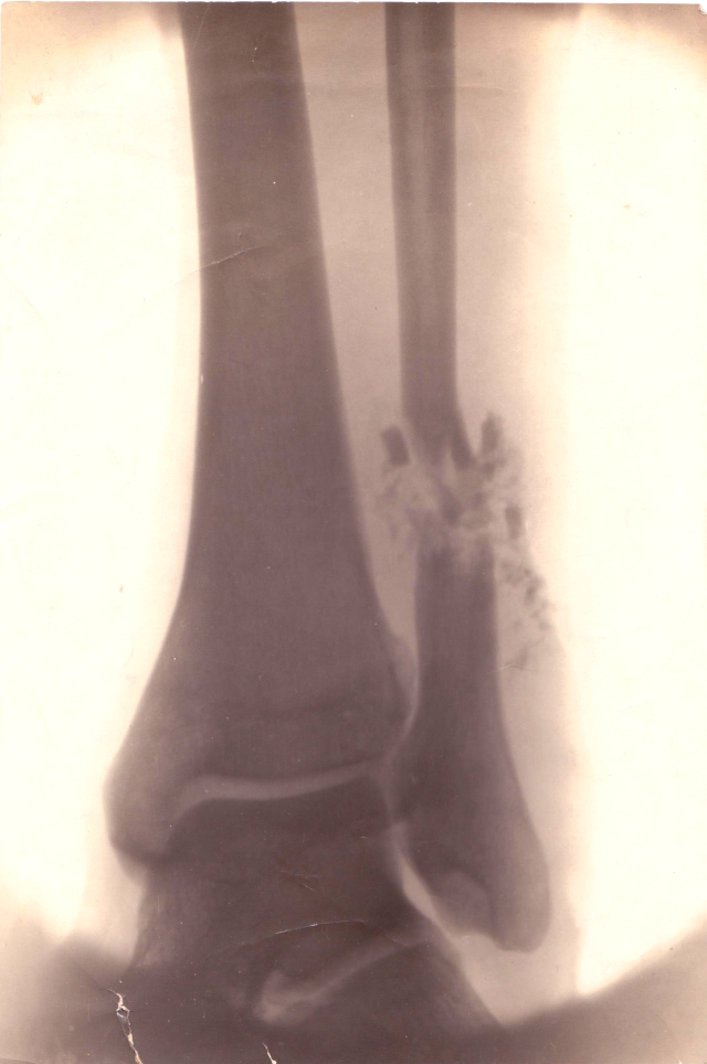 X-ray of Calderon's left lower leg 30 October 1914.